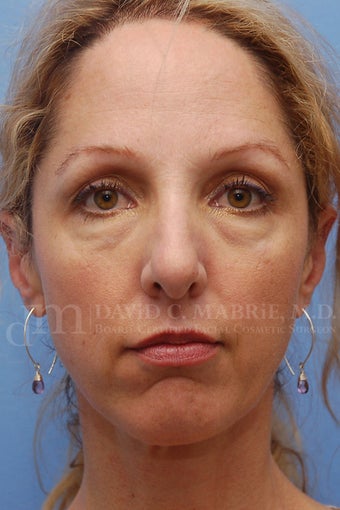 Cheek Dermafillers, Eye Dermafillers, Facial Dermafillers before 238421