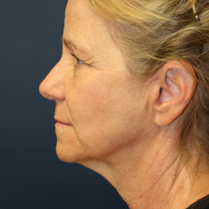 45-54 year old woman treated with Eyelid Surgery before 3555337