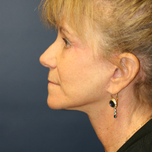 45-54 year old woman treated with Eyelid Surgery after 3555337