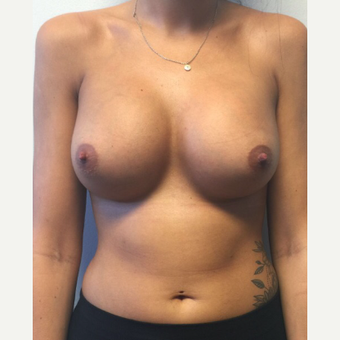 18-24 year old woman treated with Breast Augmentation after 3400568