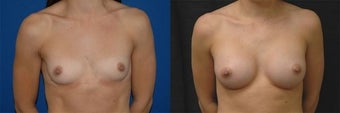 22 year old woman treated with Breast Augmentation before 3004703