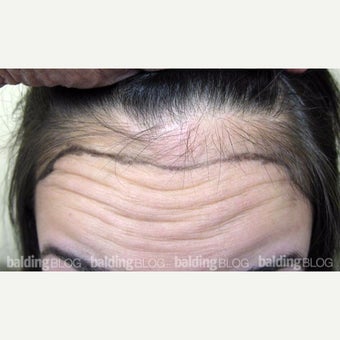 18-24 year old woman treated with Forehead Reduction with Hair Transplant before 1973894