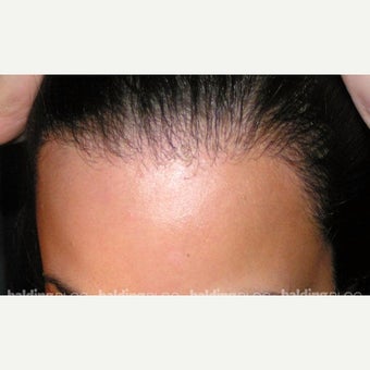 18-24 year old woman treated with Forehead Reduction with Hair Transplant after 1973894