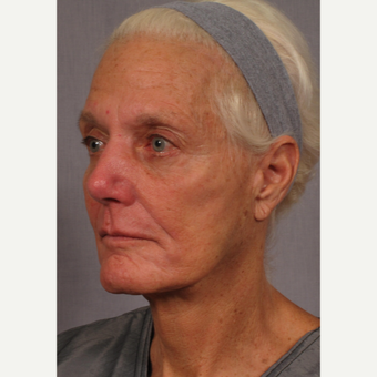 65-74 year old woman treated with Facelift after 3176733