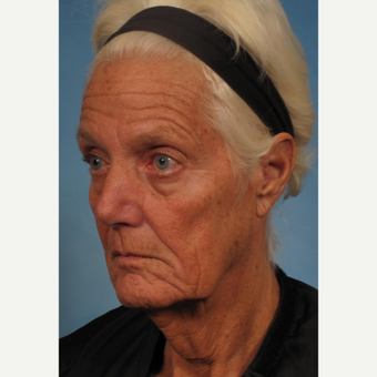 65-74 year old woman treated with Facelift before 3176733
