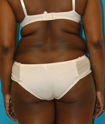 25-34 year old woman treated with Tummy Tuck 1668734