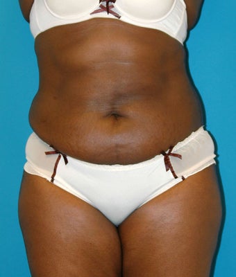 25-34 year old woman treated with Tummy Tuck before 1668734