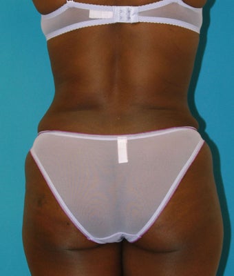 25-34 year old woman treated with Tummy Tuck 1668734