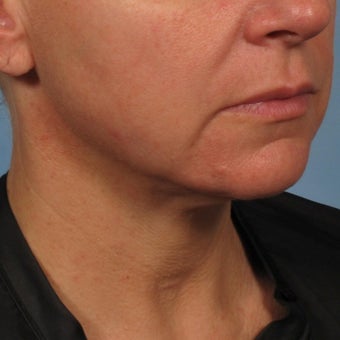 45-54 year old woman treated with Minimally Invasive Neck Lift - Precision TX Laser Neck Lift after 2015561