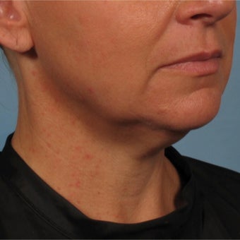 45-54 year old woman treated with Minimally Invasive Neck Lift - Precision TX Laser Neck Lift before 2015561