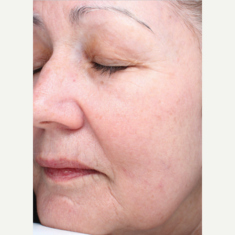 Halo Laser after 1833363
