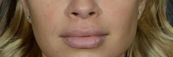 Lip Lift to give a better definition and shorten a heavy lip after 1521385