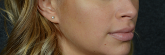 Lip Lift to give a better definition and shorten a heavy lip 1521385