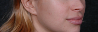 Lip Lift to give a better definition and shorten a heavy lip 1521385