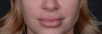 Lip Lift to give a better definition and shorten a heavy lip before 1521385