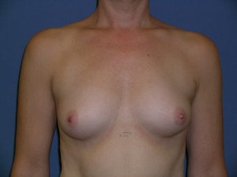 Breast Augmentation before 88345