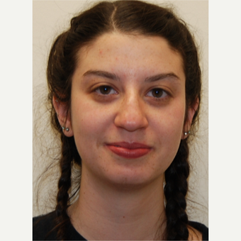 18-24 year old woman treated with Rhinoplasty before 3813726