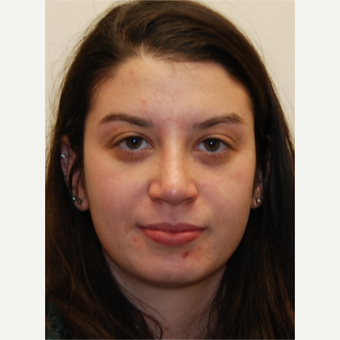 18-24 year old woman treated with Rhinoplasty after 3813726