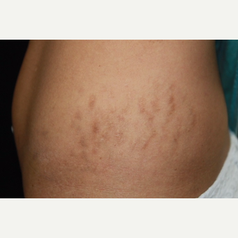 32 year old female treated with Fraxel for stretch marks (striae) after pregnancy. before 3010597
