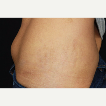 32 year old female treated with Fraxel for stretch marks (striae) after pregnancy. after 3010597