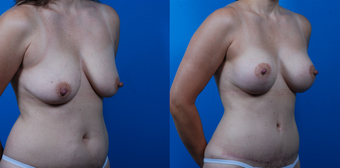 43-year-old woman treated with a Mommy Makeover. after 1058360