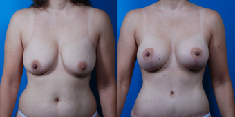 43-year-old woman treated with a Mommy Makeover. before 1058360