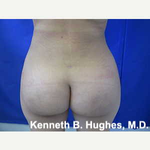 Liposuction after 3094239