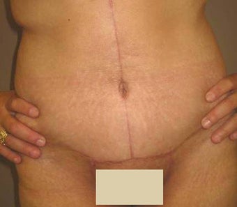 Body Lift after 143988