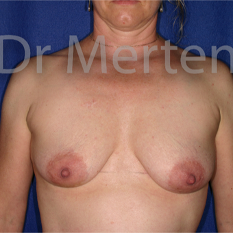35-44 year old woman treated with Breast Augmentation before 3555414