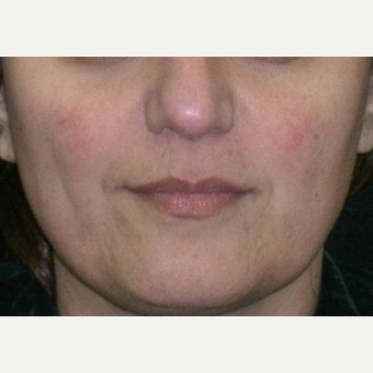 35-44 year old woman treated with IPL before 3147014