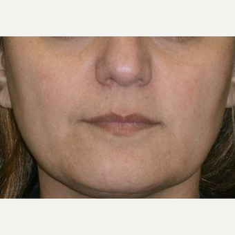 35-44 year old woman treated with IPL after 3147014