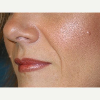 35-44 year old woman treated with Juvederm before 2368380