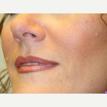 35-44 year old woman treated with Juvederm after 2368380
