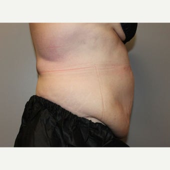 55-64 year old woman treated with SculpSure after 2592282