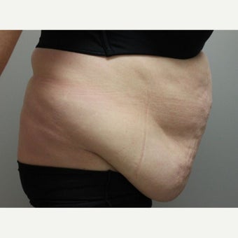 55-64 year old woman treated with SculpSure before 2592282