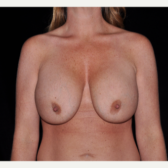 35-44 year old woman treated with Breast Augmentation before 3617901