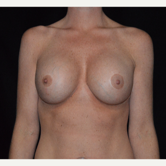 35-44 year old woman treated with Breast Augmentation after 3617901