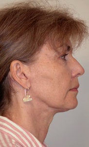 Before and After Neck Lift (Side View) after 65353