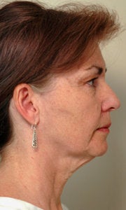 Before and After Neck Lift (Side View) before 65353