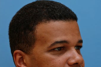 Young Man with Heavy Forehead and Temple Scar after 1419409