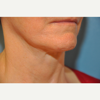 65-74 year old woman treated with ThermiTight before 3075717