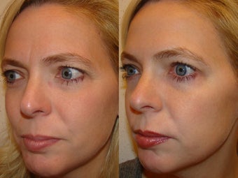 Female treated for glabella, forehead and crows feet before 971189