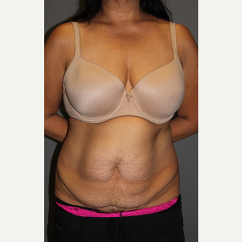 45-54 year old woman treated with Tummy Tuck before 3129271