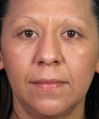 Mole Removal Example from Left Cheek after 877490
