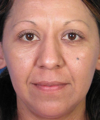 Mole Removal Example from Left Cheek before 877490