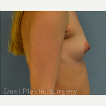 25-34 year old woman treated with Breast Augmentation before 3342192