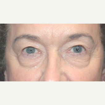 Eyelid Surgery before 3346387