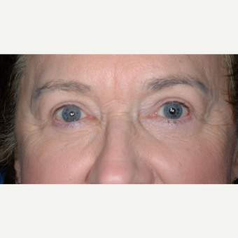 Eyelid Surgery after 3346387