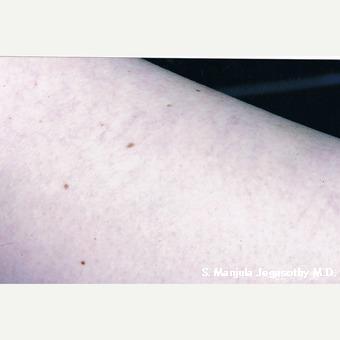 Sclerotherapy after 1631862