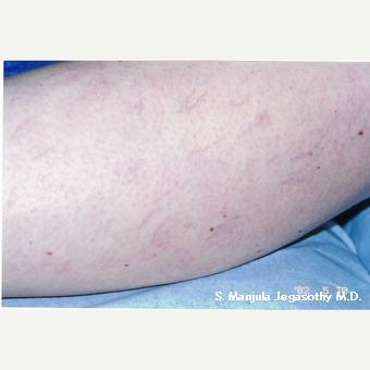 Sclerotherapy before 1631862